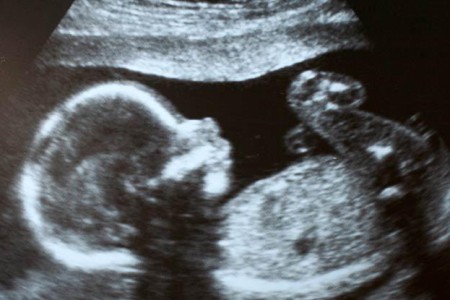 Cryptic Pregnancy