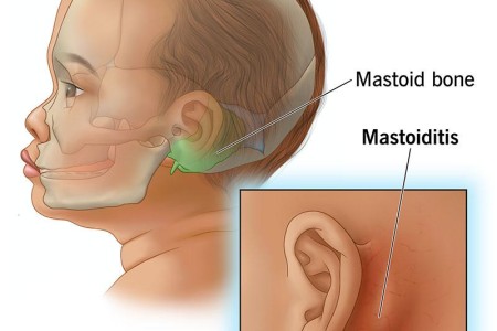 Mastoiditis
