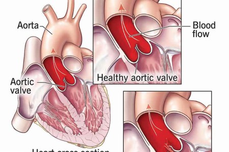 Aortic Regurgitation