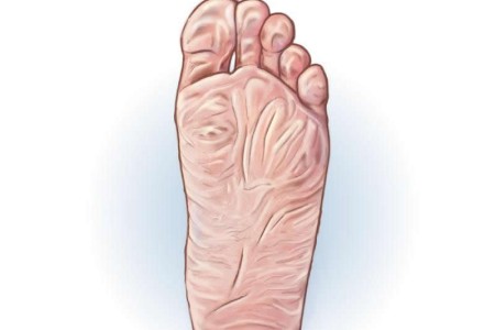Trench Foot