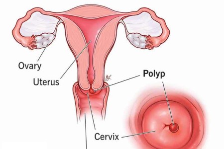 Cervical Polyp