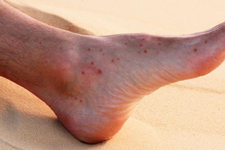 Sand Flea Bites