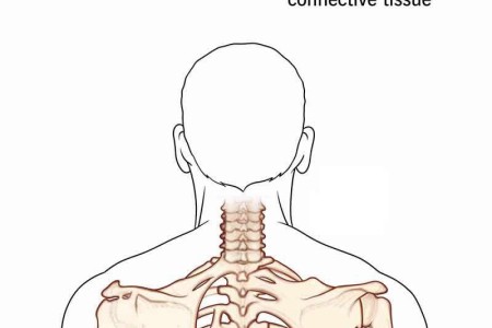 Fibrodysplasia Ossificans Progressiva