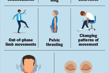 Psychogenic Nonepileptic Seizure (PNES)