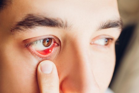 Internal Stye