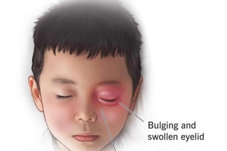 Orbital Cellulitis