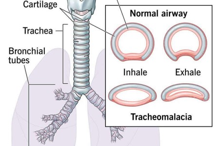 Tracheomalacia