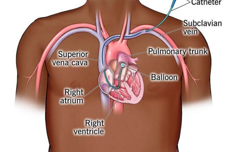 Swan-Ganz Catheterization