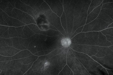 Fluorescein Angiography