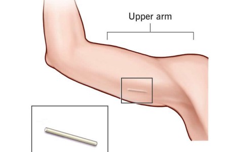 Contraceptive Implant
