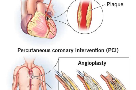 Coronary Revascularization