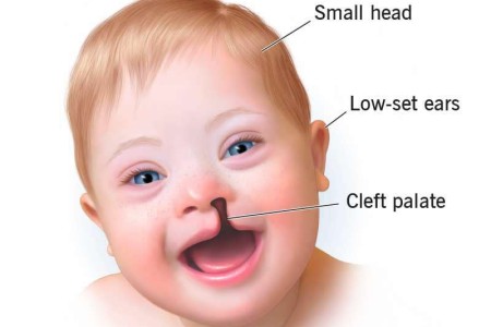 Trisomy 13 (Patau Syndrome)