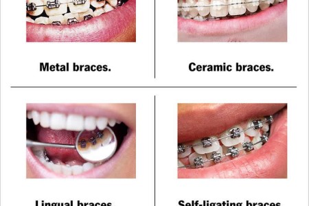 Teeth Braces