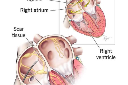 SVT Ablation