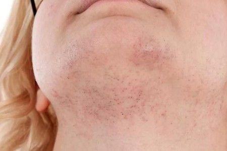 Why Do Women Get Chin Hair?