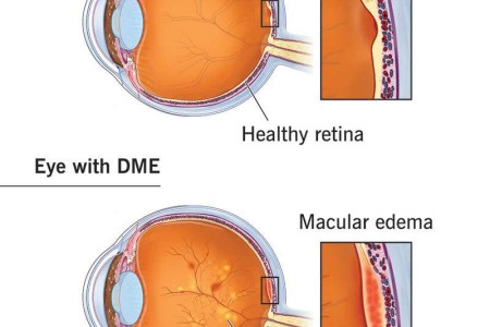 Diabetes-Related Macular Edema