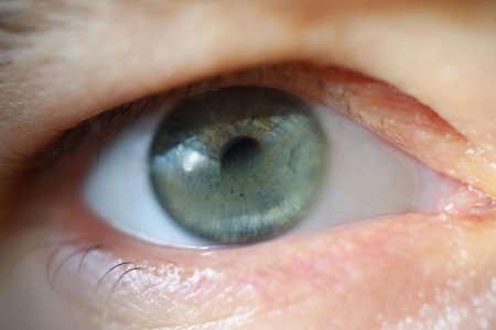 Band Keratopathy