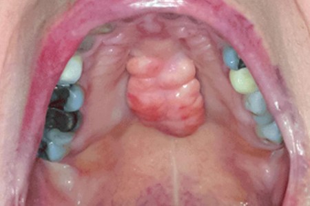 Torus Palatinus (Palatal Tori)