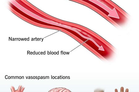 Vasospasm