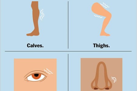 Benign Fasciculation Syndrome