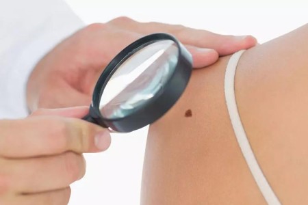 The Rise of Basal Cell and Squamous Cell Carcinomas: What’s the Difference?