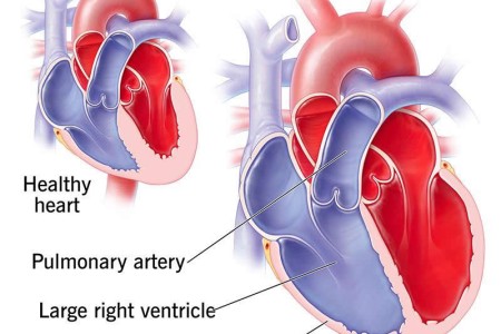 Cor Pulmonale (Right-Sided Heart Failure)
