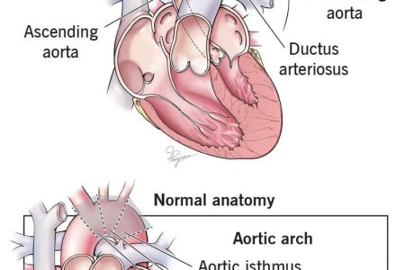 Hypoplastic Aortic Arch
