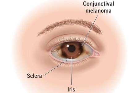 Conjunctival Melanoma