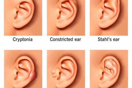Ear Deformity