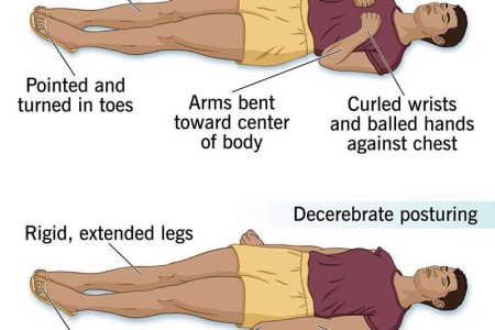 Decorticate Posturing