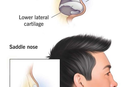 Saddle Nose