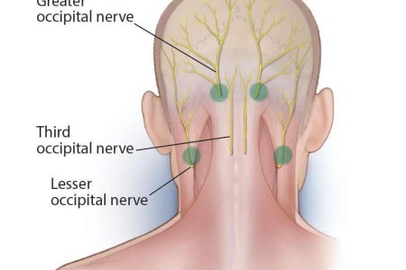 Occipital Nerve Block