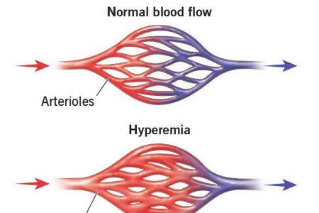 Hyperemia