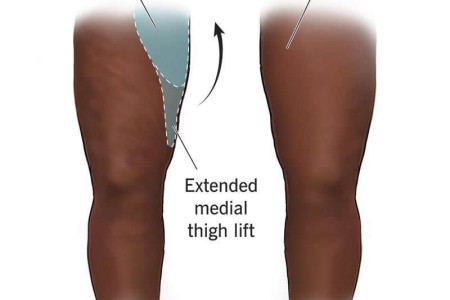 Thigh Lift (Thighplasty)