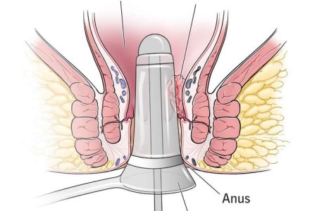 Anoscopy