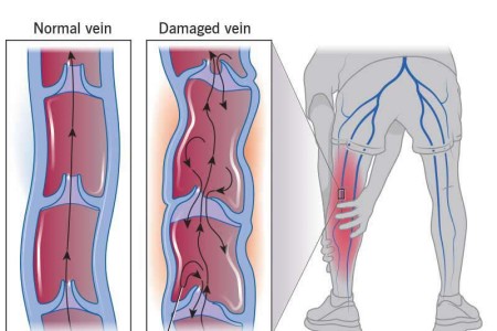 Post-Thrombotic Syndrome