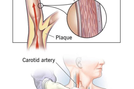 Carotid Intima-Media Thickness (CIMT) Test