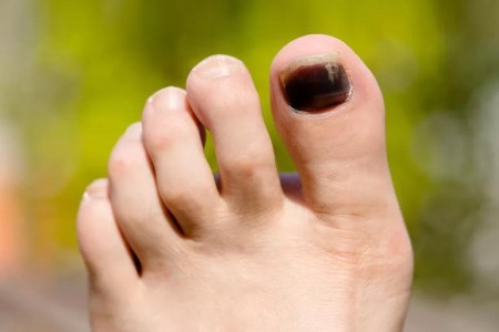 Damage Control: What To Know About Runner’s Toe