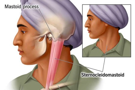 Sternocleidomastoid (SCM) Muscle