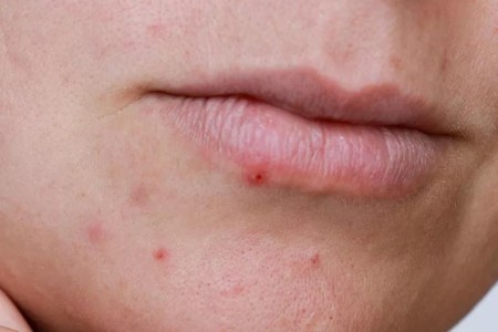 Lip Service: How To Get Rid of Lip Pimples