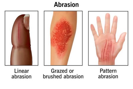 Abrasion (Scrape)