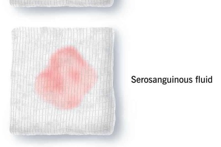 Serous Drainage