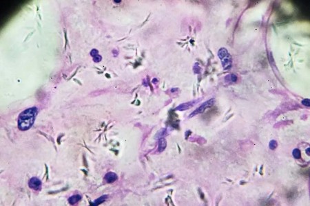 Carcinoma vs. Sarcoma: What’s the Difference?