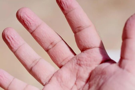 Why Water Turns Fingers and Toes Into Prunes