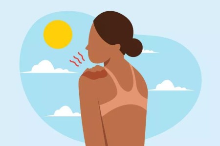 Tips for Treating a Peeling Sunburn