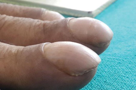 Nail Clubbing