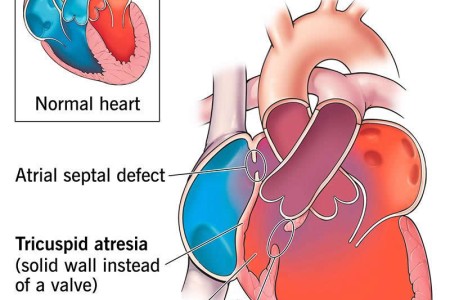 Tricuspid Atresia
