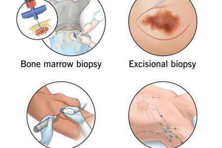 Biopsy