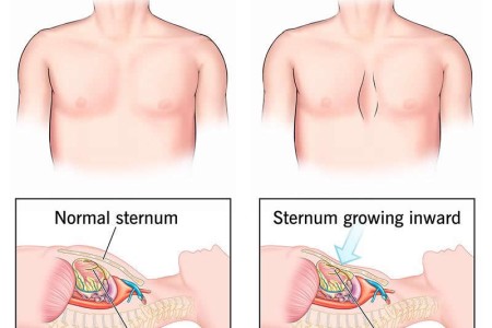 Pectus Excavatum