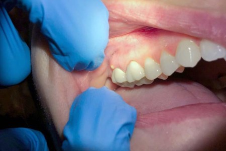 Abscess